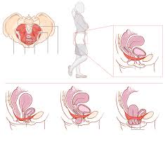 Prolapse When The Pelvic Floor Collapses Pelvic Floor Pelvic Floor Dysfunction Pelvic Floor Prolapse