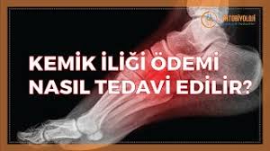 kemik iligi odemi nasil tedavi edilir youtube