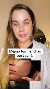 Se Puede Mezclar Niacinamida Y Antipigmen Eucerin