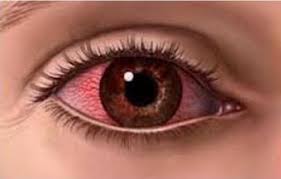 We did not find results for: Allvision Machang Kelantan Mata Kering Apa Itu Mata Kering Mata Kering Berlaku Kerana Kekurangan Air Mata Untuk Melembapkan Mata Punca Punca Mata Kering Peningkatan Usia Kesan Pengambilan Ubat Ubatan Faktor