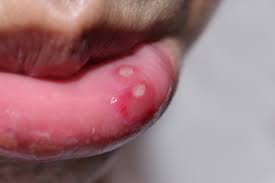 My lips went from looking dark , dry unhealthy in the left to a little bit pink and healthy looking in the right below. 7 Home Remedies For Canker Sores Consumer Guide To Dentistry