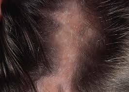 A hair growth cycle comprises two phases, namely anagen (growth phase) and telogen loss of hair may dishearten you, but hair fall after pregnancy could be managed. Can Pantoprazole Cause Hair Loss Quora