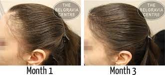 Hair loss is a symptom. Traction Alopecia Information And Treatment From The Belgravia Centre
