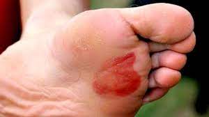 Seguir las siguientes recomendaciones puede ayudar a prevenir la aparición de las molestas ampollas en nuestro día a día: Como Evitar Ampollas En Los Pies Por Que Salen Y Como Prevenirlas