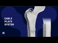 Cable Plate System
