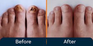 Image result for Toenail Removal