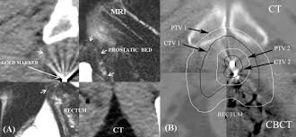 Only 1 patient has developed a urinary tract infection requiring additional antibiotic … Transrectal Implantation And Stability Of Gold Markers In Prostate Bed For Salvage Radiotherapy Of Macroscopic Recurrences Physica Medica European Journal Of Medical Physics