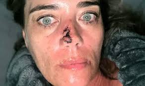 Image result for skin cancer on nose pimple