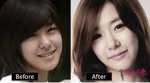 Tiffany Snsd Plastic Surgery Url Https Plasticessurgery Blogspot Com 2018 07 Tiffany Snsd Plastic Surgery Html Plastic Surgery Surgery Snsd