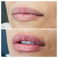 We did not find results for: Dermal Filler Before And Afters In Denver Co The Luxe Room