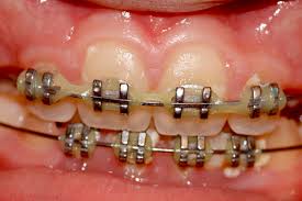 The number cannot be completed as dialed. 10 Important Things To Know Before You Get Dental Braces