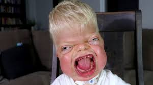 Leo is diagnosed with Pfeiffer syndrome and hopes others say “I love you”  upon meeting him. When he grows up Leo hopes to be a superhero while  playing professional sports