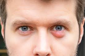 Often a dark crust develops in the middle, which could bleed with a light touch. Bump Under Eyelid Skin Cancer Or Chalazion Cyst Scary Symptoms