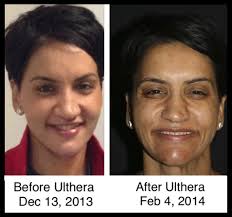 My Ultherapy Damage Posts Facebook