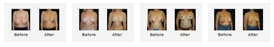 Plastic Surgery Costs In Canada 2024 | Mcrae Plastic Surgery
