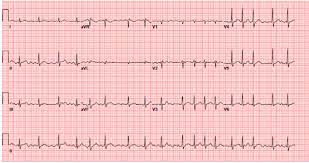 Lyme Carditis Presenting As Atrial Fibrillation Bmj Case Reports