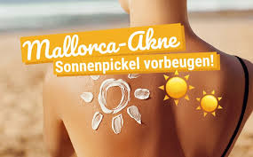 Treten die symptome bei dir auf, solltest du auf jeden fall eine dermatologin oder einen dermatologen zu rate ziehen. Mallorca Akne Wie Du Sonnenpickel Vorbeugen Kannst The Impish Ink