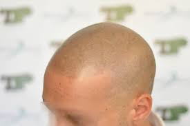 È una tecnica che consente di mascherare la calvizie in maniera più adatta a seconda della situazione da trattare (per esempio dando il cosiddetto effetto . Tricopigmentazione La Guida Definitiva Di Blogcalvizie It