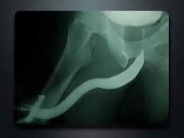 Image result for Retrograde Urethrogram