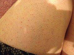 Keratosis Pilaris Is Commonly Named As Chicken Skin In Which Your Skin Gets Small Red Or White Bumps Which Remain L Skin Bumps Chicken Skin Keratosis Pilaris