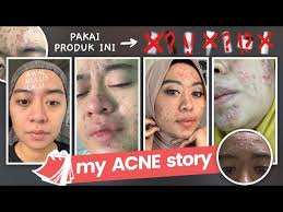 Aduklah hingga mengental seperti pasta. Jerawatan Parah Akibat Krim Pemutih Beauty Vlogger Ini Vindy Ungkap Kiat Hingga Bisa Pulih Blitar Times