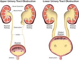 Urinary Tract Obstructions