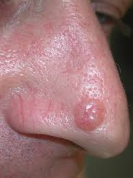 Osterreichische Gesellschaft Fur Dermatochirurgie Ogdc