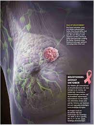 Wann ist eine neoadjuvante chemotherapie sinnvoll? Wann Brauchts Eine Chemo Luzerner Kantonsspital