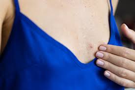 Pimple on Breast: Causes & What to Do