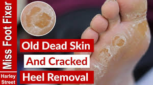 Foot calluses are also the same with areas of the skin that have become thick and hard. Old Dry Skin And Cracked Heel Removal By Miss Foot Fixer Youtube