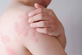 Image result for dermatitis contacta allergica