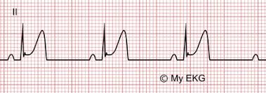 Image result for Early Repolarization
