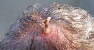 The human botfly occasionally uses humans to host its larvae. What Is A Botfly Maggot Nature S Most Disturbing Parasite