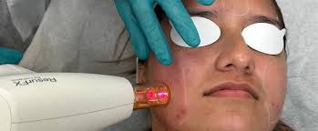 How Much Does Laser Skin Resurfacing Cost | Perfect B