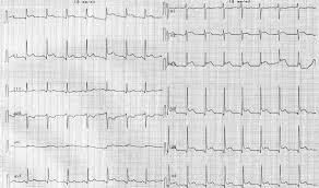 Other symptoms of pericarditis can include fever, weakness, palpitations, and shortness of. Pericardite Fichesbook