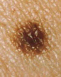 Indications that a toenail is affected by melanoma include a dark spot or streak on the nail, or an uncolored growth under the nail. Are Moles On Toes High Risk For Melanoma Scary Symptoms