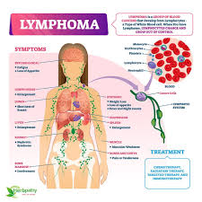Blood cancer is a serious sickness but we can protect this illness if we know about these cancers symptoms and signs. Herbpathy Com Lymphoma Definition Symptoms Causes Diagnosis And Herbal Treatment Http Bit Ly 3tldnn8 Facebook