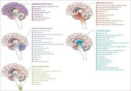 Pin On Brain Tumor Stuff