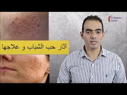 Maybe you would like to learn more about one of these? Ø£Ù†ÙˆØ§Ø¹ Ø¢Ø«Ø§Ø± Ø­Ø¨ Ø§Ù„Ø´Ø¨Ø§Ø¨ Ùˆ Ø·Ø±ÙŠÙ‚Ø© Ø¹Ù„Ø§Ø¬Ù‡Ø§ Ø¯ Ù…Ø­Ù…Ø¯ Ø§Ù„Ù†Ø§Ø¸Ø± Youtube