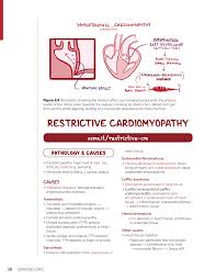 Image result for Restrictive Cardiomyopathy