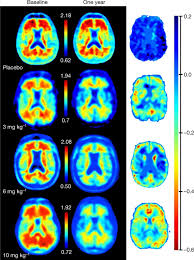 Chance the primary efficacy endpoint analysis will be statistically significant in favor of aducanumab given interim data. Addendum The Antibody Aducanumab Reduces Ab Plaques In Alzheimer S Disease Nature