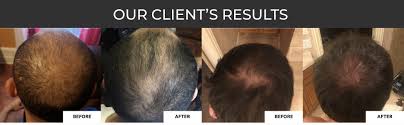 6 customers already purchased revita hair loss shampoo 205ml and received it in. Amazon Com Revita Hair Growth Stimulating Shampoo 205ml For Thinning Hair Hair Growth Beauty