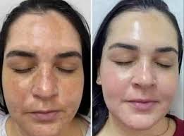 FLUIDO DE ÁCIDO HIALURONICO ✴️Es para todo tipo de piel✴️ 🤩Pará el cuidado  y limpieza de la piel🤩 ✨ quita marcas ✨quita sicatrices ✨ayuda a  desaparecer estrias ✨ Te quita paño y