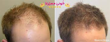 السدر لتطويل الشعر و علاج التقصف الخلطات و تجربتي قبل و بعد بالصور