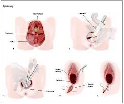 Berapa lama waktu yang diperlukan untuk pulih dari infeksi? Akibat Luka Jahitan Seksa Dan Derita