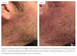 People have widely varying opinions on what's considered excessive. Beard And Moustache Restoration Aesthetics