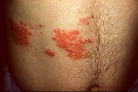 Resultado de imagen para Infecciones Viricas