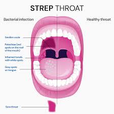 Image result for Strep throat infection roof of mouth