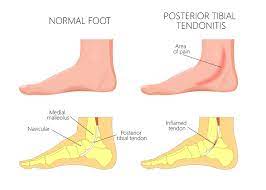 Posterior Tibial Tendonitis Posterior Tibial Tendon Dysfunction Plantar Fascia Institute Of Mn