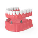 Dentures Chicago Loop, IL | Dental Prosthetics